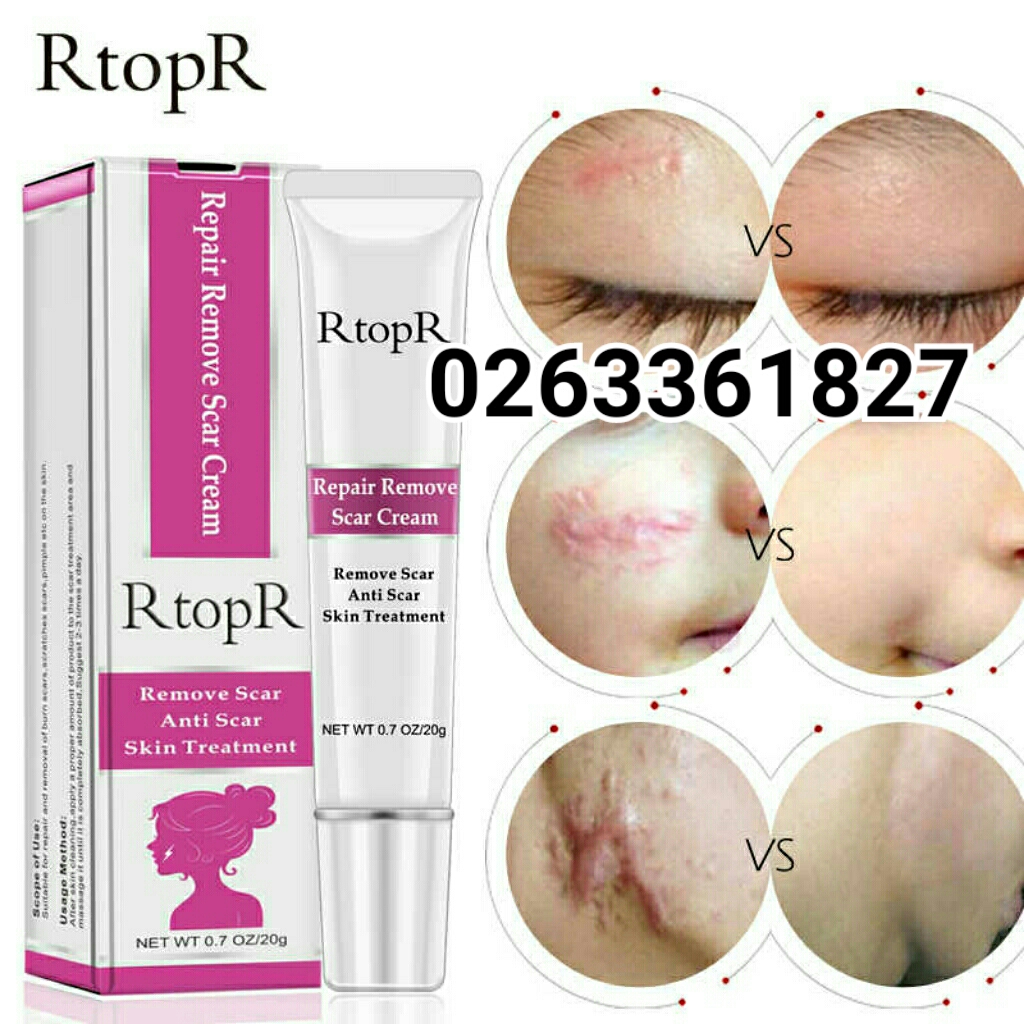 Rtopr scar and acne removal