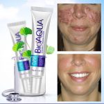BioAqua Acne Removal Cream
