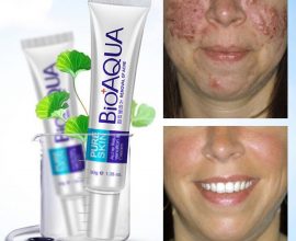 acne removal cream