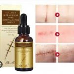 Scars Removal Oil