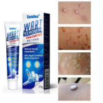 Wart Remover Ointment Wart Remover Ointment
